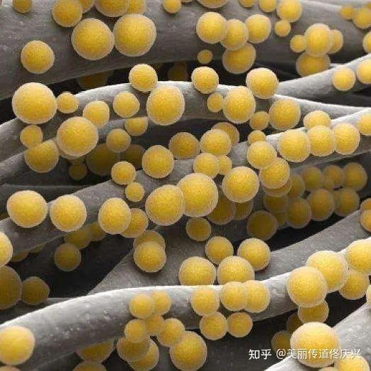 例如:金黄色葡萄球菌(金球菌)一直被认为是皮肤疾病危害最大的致病菌