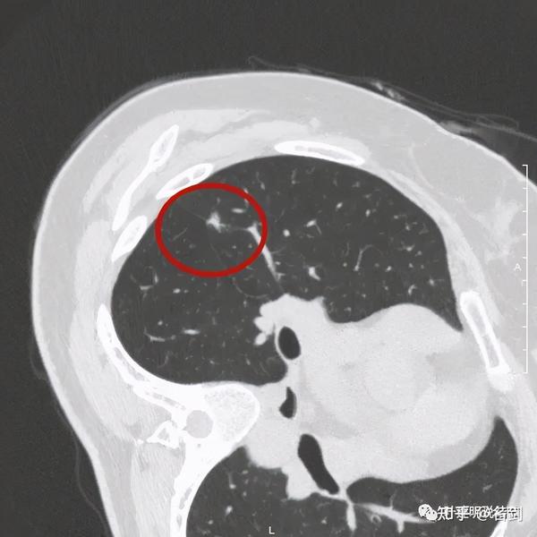 罕见病例:存在了4年多的肺结节是不是癌?术中病理也难以区分!