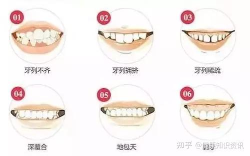 【健康正畸美妙微笑】儿童牙齿矫正的"黄金期",千万别错过!