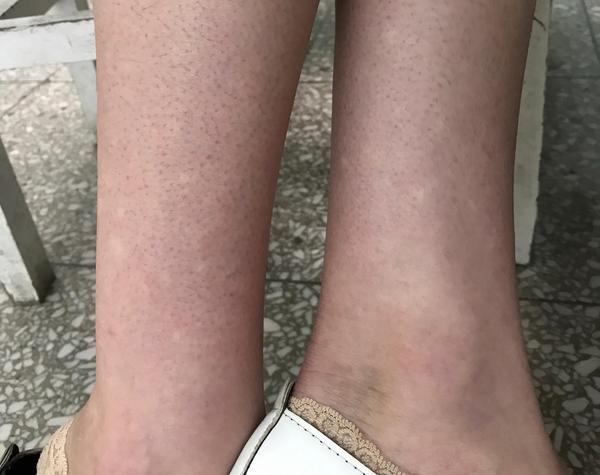 小腿莫名出现很多白斑以为是白癜风原来是虚惊一场