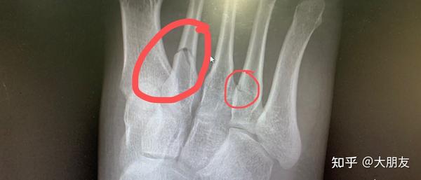 右脚第二第四跖骨(脚趾骨)骨折