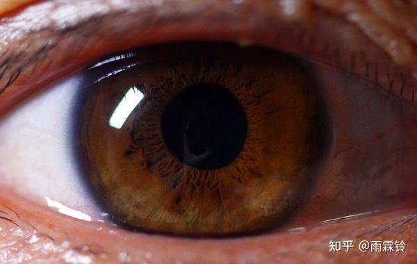 瞳孔是人眼睛内虹膜中心的小圆孔,巩括约肌收缩,使瞳孔缩小