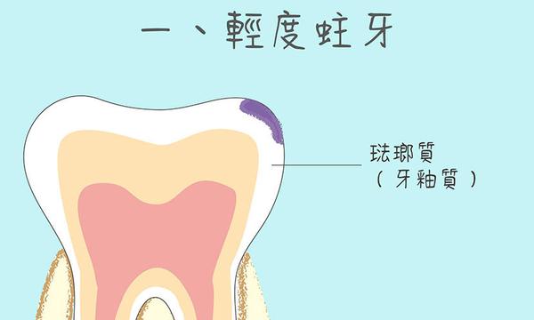 停止腐蚀方法:去牙科诊所找牙医,磨除龋坏的牙釉质,然后在牙齿上涂上