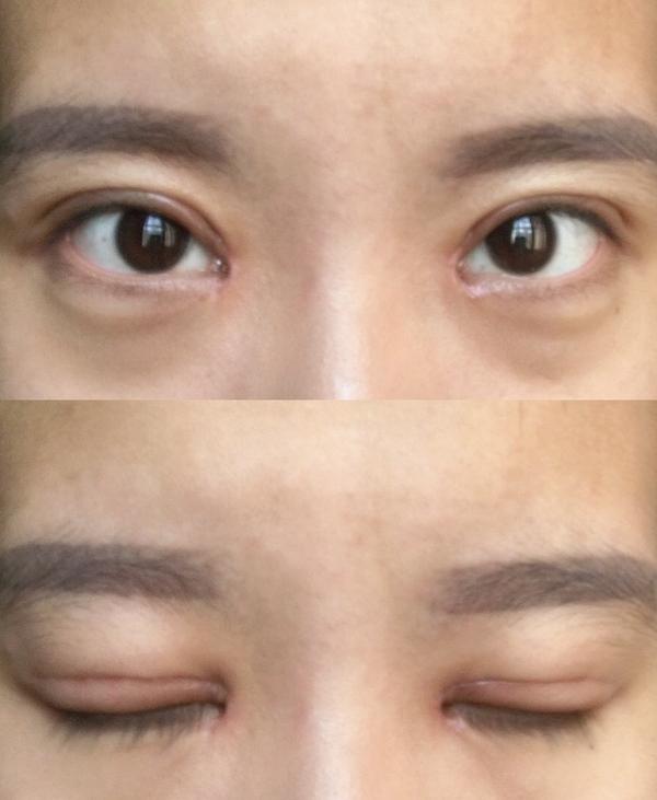 双眼皮手术后15天了,靠近眼角的是瘢痕增生吗?