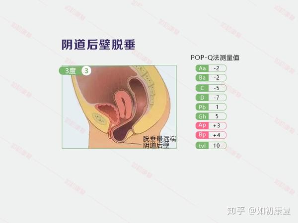 阴道膨出子宫下垂了几厘米属于什么程度几张图片告诉你