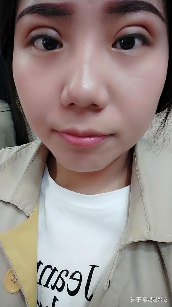 记录我的埋线双眼皮恢复过程