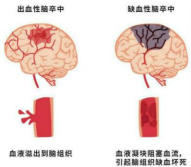 为什么多数脑卒中只影响对侧肢体