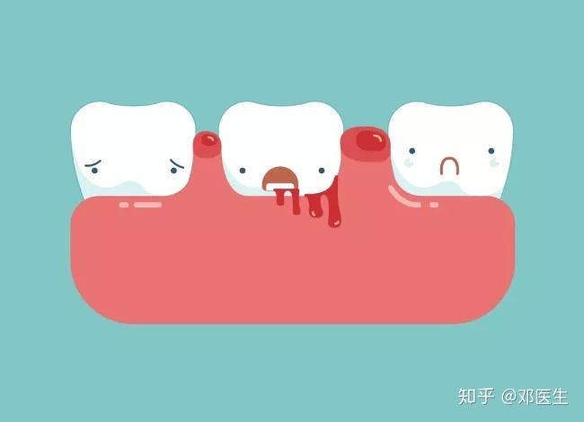牙周炎会导致牙齿发生不同程度的松动,移位及牙龈退缩,不容忽视.