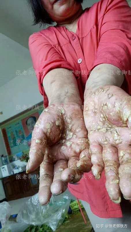 新乡赵女士手藓反馈 2.19
