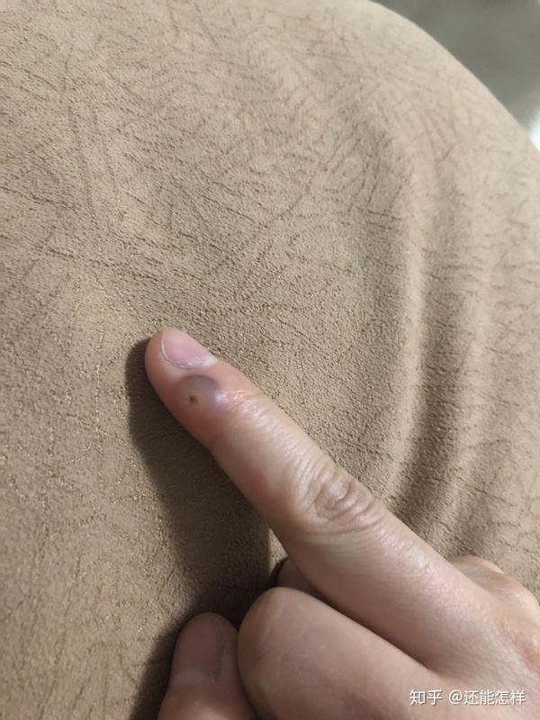 疣,说是瘊子,冷冻了两个多星期了,谁能告诉我现在该怎么办 ?