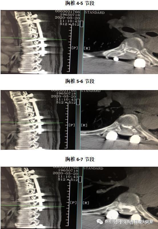 上海市一脊柱外科勇闯极限手术:胸椎黄韧带骨化合并后