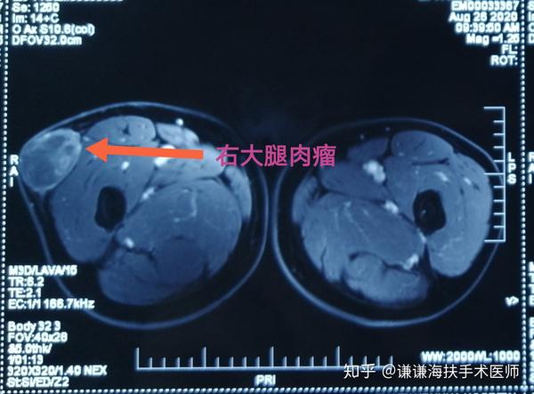 脂肪肉瘤诊治病例分享
