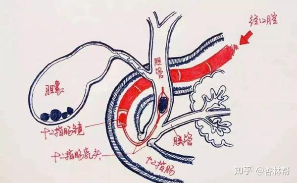 梗阻性黄疸的ercp治疗
