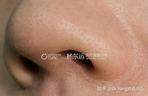 一例鼻翼缩小术后恢复情况