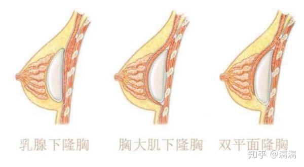 假体隆胸千万不要做隆胸有哪些后遗症