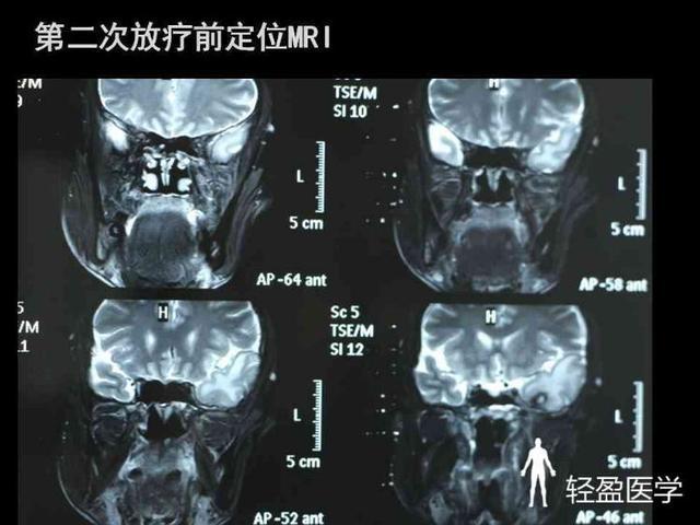 你离鼻咽癌还有多远来了解下鼻咽癌吧经典案例