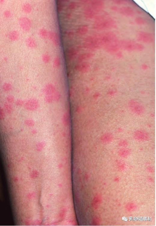 最初病变可能为圆形红斑状丘疹,然后进展为典型的靶形皮损.