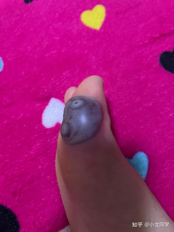 冷氮去病毒疣的过程