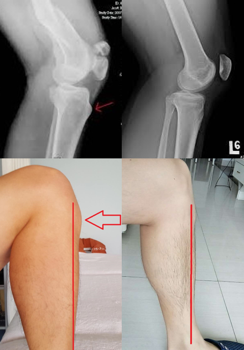 「奥斯古膝」临床名称为胫骨粗隆骨骺炎,疼痛位置于髌腱连接至胫骨的