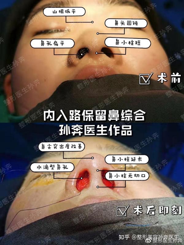 隆鼻后会出现鼻头坏死是什么原因造成的