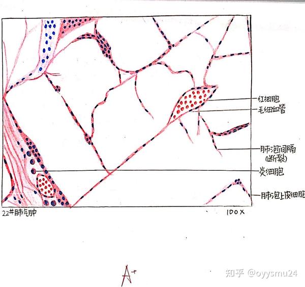 肺气肿