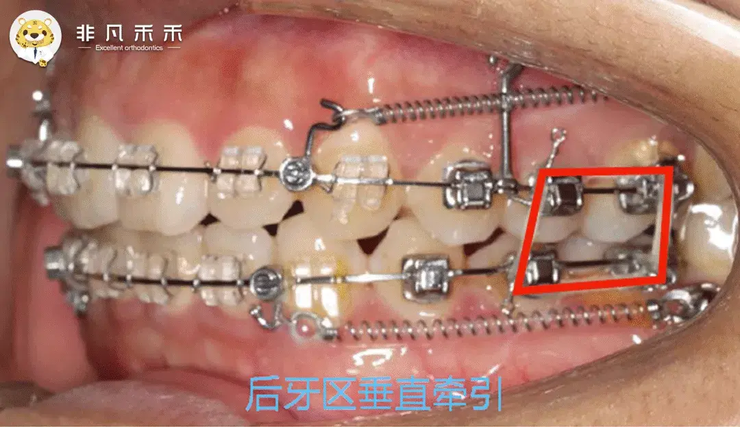 正畸病例牙不齐牙突嘴突不拔牙矫治病例1例