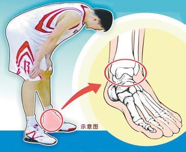 脚扭伤也要打石膏,医生是不是搞错了