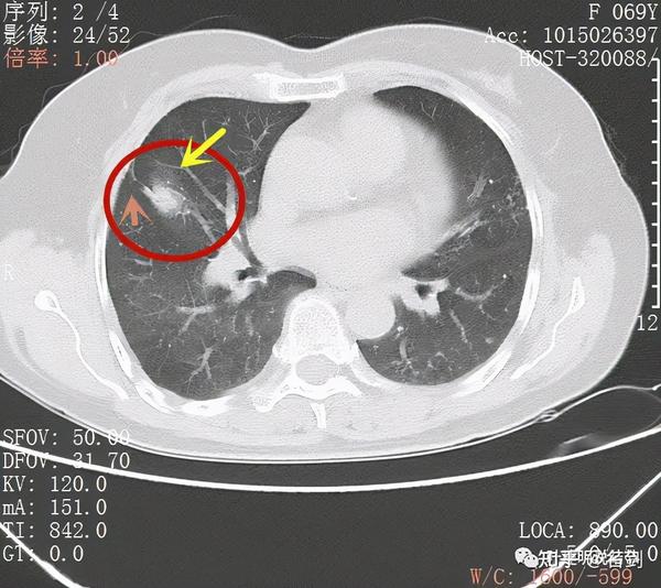 这样的肺部阴影会不会是癌有时靠第六感