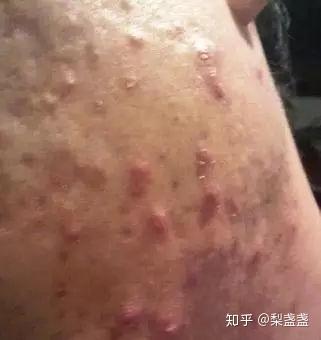 脸上的青春痘没有化脓,反而变成硬块了,怎么办? 高能预警! . . . . .