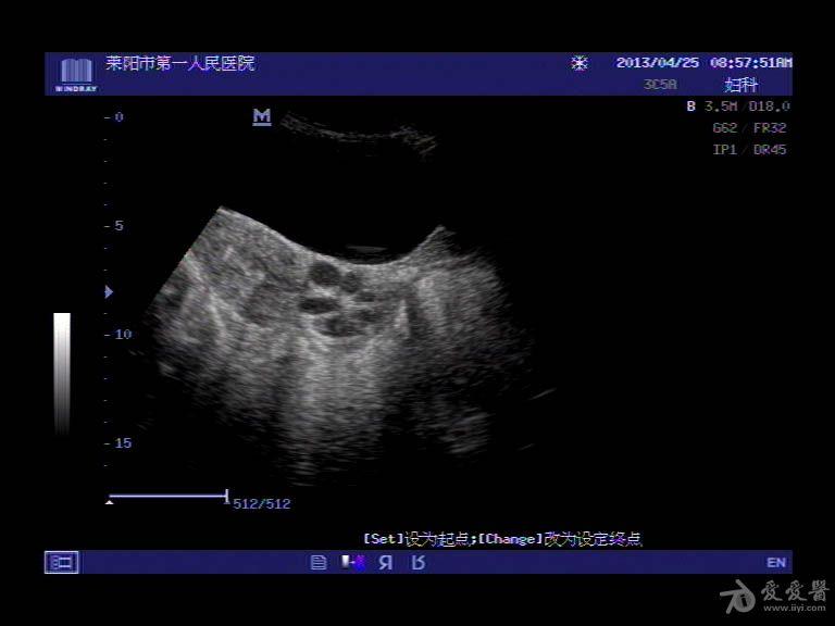 病人拿着这样的超声报告单,心惊胆战的来求助:大夫,我宫颈上长了囊肿