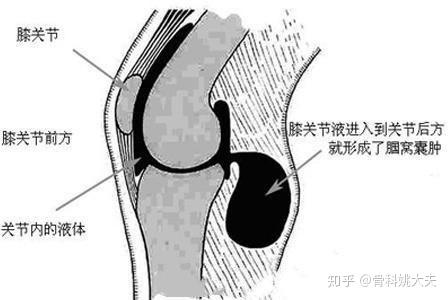 对于小的腘窝囊肿,如果腿部没有什么不舒服,可以暂时观察.