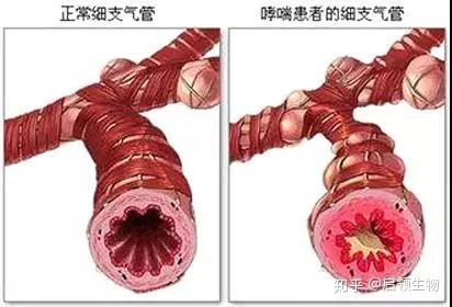 哮喘患者支气管与正常支气管对比图