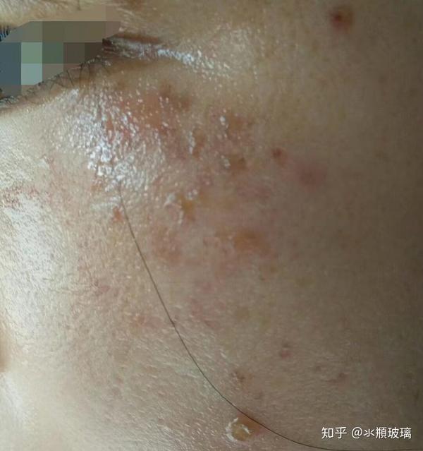 深浅收费的,由于我有关系一直没有花钱,治疗的病有很多,什么鲜红斑痣