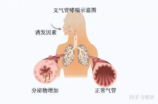 支气管炎和哮喘的区别