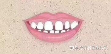 哪些情况会出现牙齿稀疏,牙缝大?
