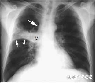且常常伴有胸痛(痛到不敢呼吸,小编体验过)和浓痰甚至血痰;肺癌也有
