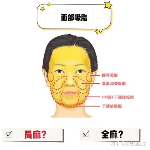面部吸脂选择局麻吸脂还是全麻
