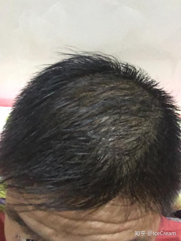 先说下我的经历:我大一的时候就开始头发发油,然后头顶左侧就慢慢变稀