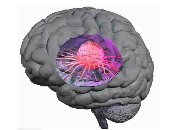 重疾理赔解释系列10——良性脑肿瘤