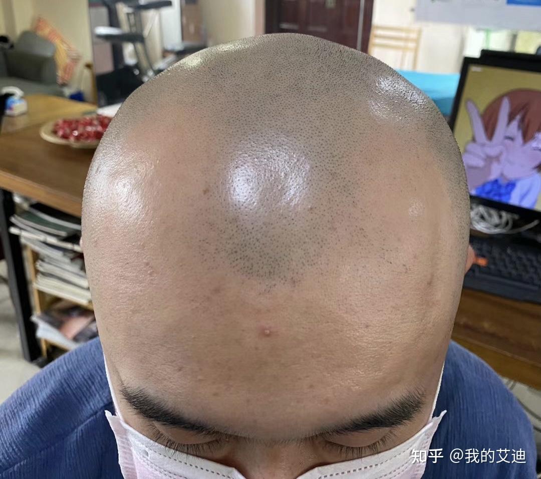 纹发一年以后的效果