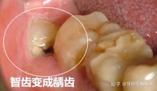 2,龋齿(蛀牙) 如果智齿出现龋坏,就需要进行补牙或是根管治疗,不然的