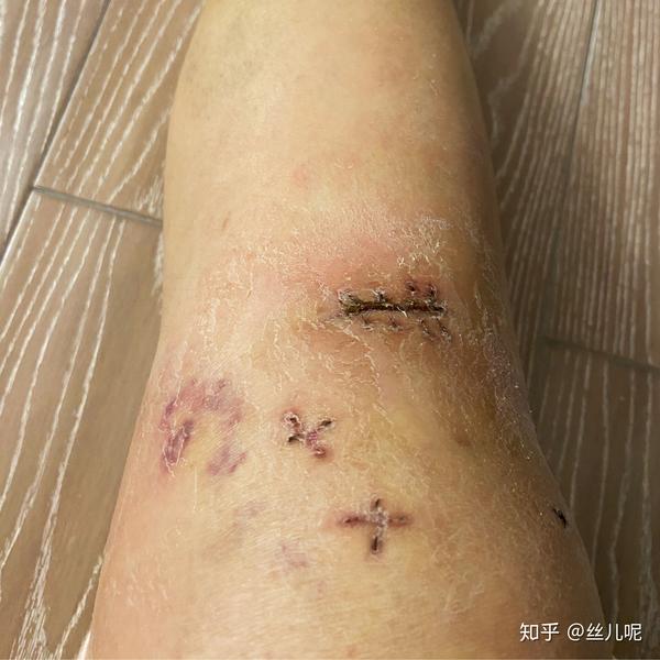 腿伤口下面的淤血也渐渐散开来,肿痛抵不过康复的疼.    拆线了