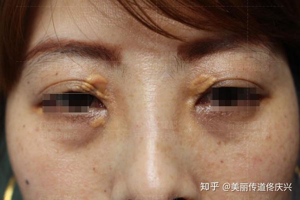 睑黄瘤
