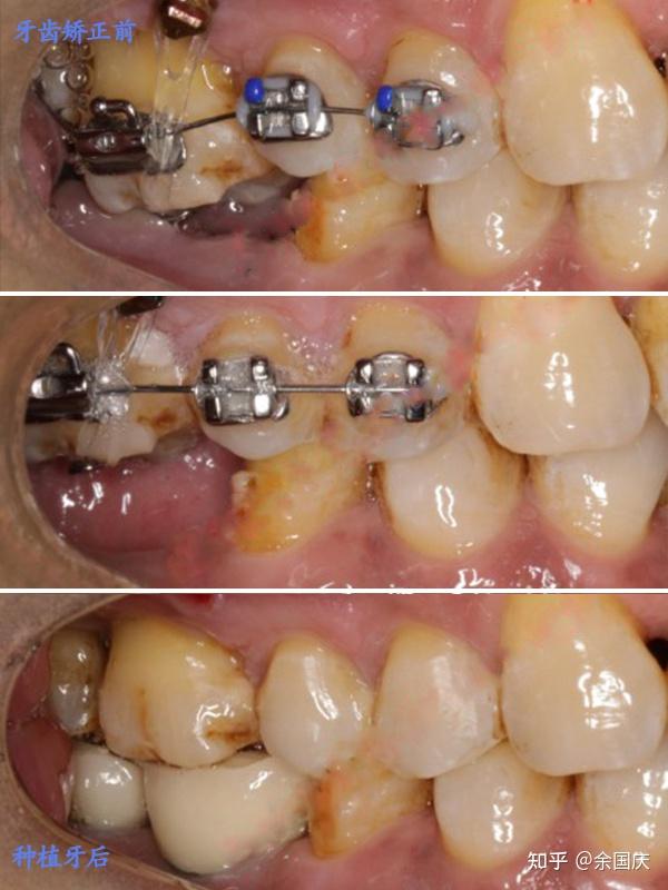 种植牙是没有牙周膜的,不能移动,如果强行正畸移动牙齿,对种植牙来说