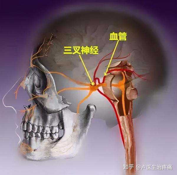 浅谈三叉神经痛的基本认识