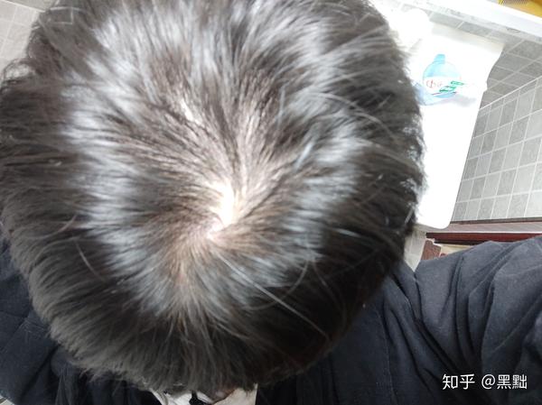 头发本来就细软,然后发现这两年发旋头发很少,有没有什么好方法可以让