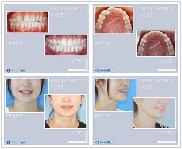 杭州牙齿矫正,隐形隐适美矫正对脸型的改变真的很大吗
