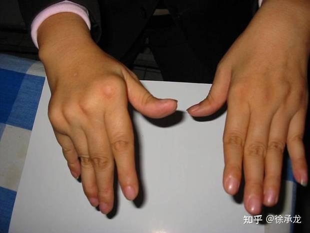 类风湿病的手指症状检测要点