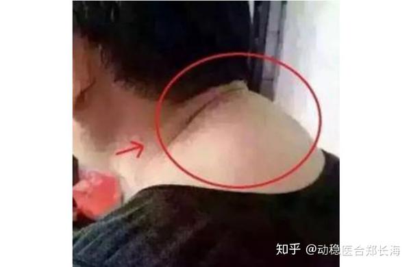 拯救颈后大包