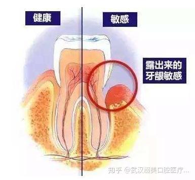 牙龈萎缩,指的是牙根部位的牙龈退缩,将牙根暴露出来,所以你的牙齿会